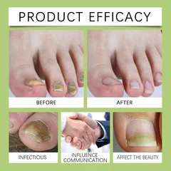 Onychomycosis Treatment Liquid Strong Formula Thickened Discolored Damaged Nail Care 30ml-7